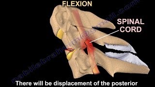 Tear Drop Fracture of the cervical spine  Everything You Need To Know  Dr Nabil Ebraheim [upl. by Pepe]