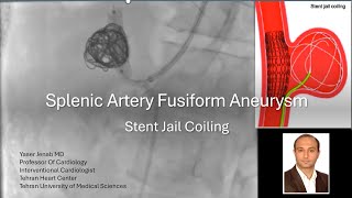 Splenic artery aneurysm stent jail coiling [upl. by Jueta]