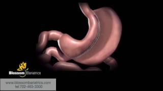 Gastric Sleeve Surgery Explained  Blossom Bariatrics  Las Vegas [upl. by Ekim]