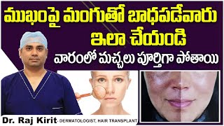 How to Get Rid of Melasma on Face  Melasma Solution in Telugu  Celestee Skin And Hair Clinic [upl. by Pooi]