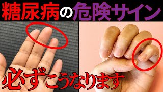 【医師監修】絶対に見逃してはいけない「糖尿病の手からの危険サイン」症状から予防法まで徹底解説 [upl. by Akimed]