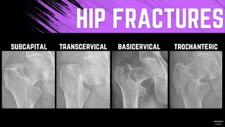 Hip Fractures and Treatment Methods Explainer with Xray examples [upl. by Lemaj]