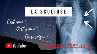 Comment lutter contre une scoliose [upl. by Adigun]