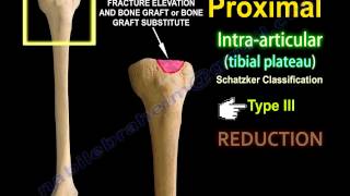 Tibial Plateau Fracture Fixation Proximal Tibia  Everything You Need To Know  Dr Nabil Ebraheim [upl. by Aicilihp]