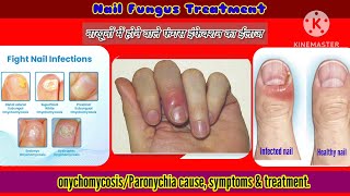 उंगली में सूजनदर्दहोने के कारण व ईलाजparonychianail fungus symptoms amp treatmenthindi [upl. by Mathew876]