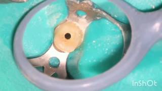 Root canal treatment full step by step [upl. by Noiramaj244]