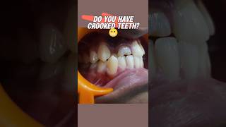 Do you have crooked teeth Watch this Dr Srishti Bhatia braces [upl. by Standush689]