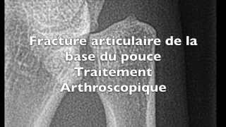 Chirurgie du pouce sous arthroscopie pour une fracture de Bennett Toulouse [upl. by Caundra]