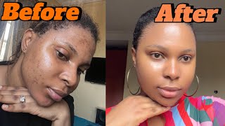 How I cleared my acne using 2 products My acne journey [upl. by Montfort80]