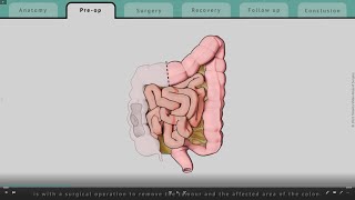 Right Hemicolectomy explained  What patients can expect  TVASurg [upl. by Neelyk386]