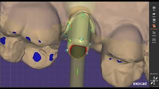 Exocad  How to design custom Abutment on Exocad [upl. by Yahsan]