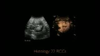 ultrasound in Renal Diseases [upl. by Elnore]