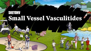 Small Vessel Vasculitides Part 1  Pathophysiology  Sketchy Medical  USMLE Step 1 [upl. by Kifar]