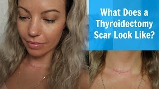 What Does A Thyroidectomy Scar Look Like [upl. by Tevlev808]