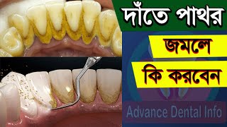 দাঁতের পাথর দূর করার উপায়  Date Pathor Dur Korar Upay  Teeth Stone Removal At Home In Bangla [upl. by Yrennalf]