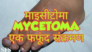 Mycetoma in hindi [upl. by Crista]