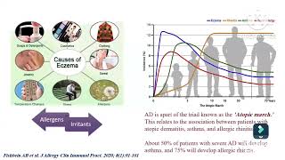 Atopic dermatitis diagnosis amp assessment Prof Ghada Shousha Pediatric immunology amp allergy Ain Shams [upl. by Eremaj958]