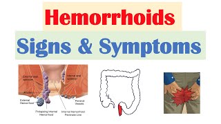 Hemorrhoids Signs amp Symptoms  Internal vs External Hemorrhoid Symptoms  Hemorrhoidal Disease [upl. by Raines]