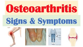 Osteoarthritis Signs amp Symptoms amp Why They Occur [upl. by Ailati446]