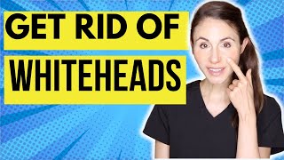 How To Get Rid Of Whiteheads On The Nose [upl. by Eduino]