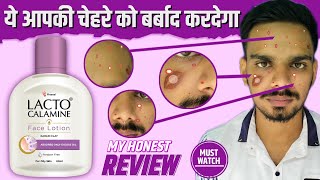 You Must Watch This Video Before Using Lacto Calamine Face Lotion [upl. by Nafis]