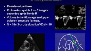 MESURE ECHOCARDIOGRAPHIQUE DU DEBIT CARDIAQUE [upl. by Fey479]