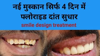 SMILE CORRECTION सामने के दांतों का 4 दिन में इलाज fluorosis teeth correction smile makeover [upl. by Wendy]