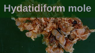 Complete Hydatidiform Mole  Pathology mini tutorial [upl. by Akinek]