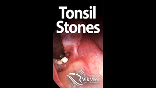 Tonsil stones forming in a large tonsil fissure [upl. by Oisor]