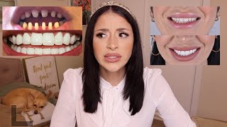 All About My Mexican Veneers  HOW MUCH DID I PAY Are They Worth It [upl. by Cartie]