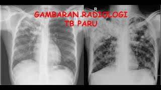 Gambaran Radiologi TB Paru [upl. by Hanson]