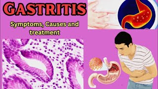 Gastritis Symptoms Causes and Treatment [upl. by Aihsiym]