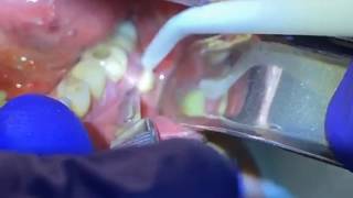 Draining a Dental Abscess  Advanced Dental Care [upl. by Dorsman]