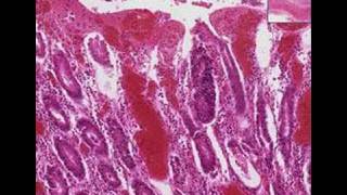 Histopathology ColonBacillary dysentery [upl. by Ymac]