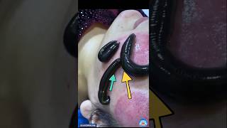 Incredible Moments of leech therapy for skin problems shorts [upl. by Yager]