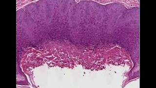 Histopathology SkinMolluscum contagiosum [upl. by Fabrienne423]