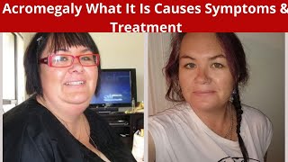 Acromegaly What It Is Causes Symptoms amp Treatment [upl. by Quenby]