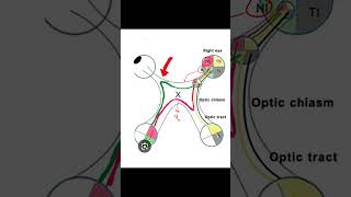 Junctional Scotoma insightophthalmology visual field ophthalmology [upl. by Aglo]