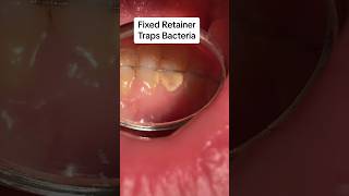 Retainers keep teeth together Removable retainers vs fixed retainer cosmeticdentistry retainers [upl. by Elleniad]