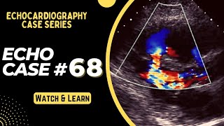 Echocardiography Case 68 Echo Spot Diagnosis Series  Echo Interpretation Made Easy [upl. by Kohsa]