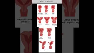 uterine anomalies  arcuate uterus septate uterus unicornuate uterus  bicornuate uterus  uterus [upl. by Arema]