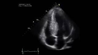 Systolic anterior motion SAM of the mitral valve in HCMP [upl. by Treve171]