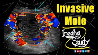 Invasive Mole  Ultrasound  Doppler  Case 244 [upl. by Klemens512]