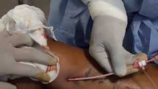 RF Ablation for Varicose Vein Radiofrequency Ablation VaricoseVeins Video [upl. by Qidas]