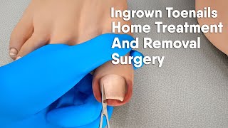 Ingrown toenail Home treatment and removal surgery3d animation [upl. by Auhsaj]