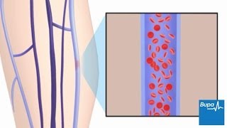 How superficial thrombophlebitis develops [upl. by Nylecyoj]