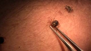 Tick attachment and removal video by B Drees and P Teel [upl. by Nyrhtakyram463]