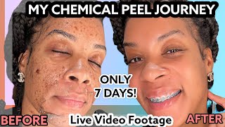 How I Cleared My Acne amp Hyperpigmentation In 7 DAYS Chemical Peel Skin Care Routine [upl. by Allred]