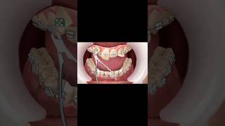 Teeth Braces🦷dentist satisfying cleaning feedshorts feed reels reel instagram shorts funny [upl. by Nelg]