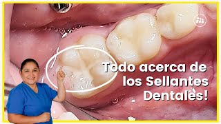 ¡✨SELLANTES DENTALES en NIÑOS protegen sus dientes de las CARIES 🦷 [upl. by Darra]